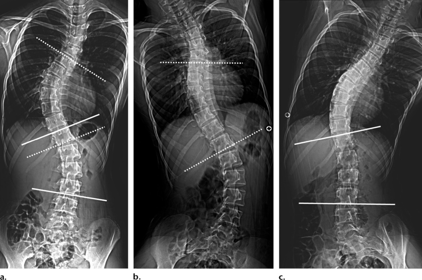 SKOLYOZ DR RADYOGRAFİSİ  ve TÜM ALT EKSTREMİTE  DR ORTORÖNTGENOGRAMI